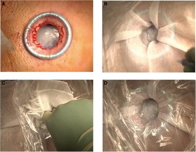 Modified Leak-Proof Puncture Technique for the Aspiration of Giant <mark class="highlighted">Ovarian Cysts</mark> by Instantly Mounting a Plastic Wrap and Gauze with Cyanoacrylates: A Retrospective Observational Study